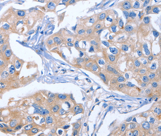 Immunohistochemistry of paraffin-embedded Human breast cancer tissue using IBSP Polyclonal Antibody at dilution of 1:50