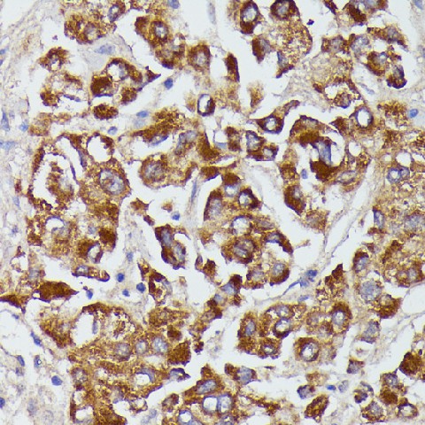 Immunohistochemistry of paraffin-embedded Human liver cancer using AGT Polyclonal Antibody at dilution of  1:100 (40x lens).