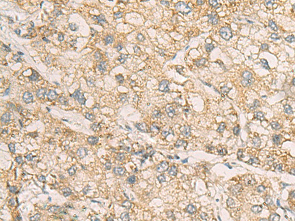 Immunohistochemistry of paraffin-embedded Human liver cancer tissue  using STX5 Polyclonal Antibody at dilution of 1:70(?200)