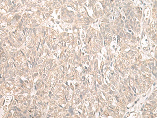 Immunohistochemistry of paraffin-embedded Human ovarian cancer tissue  using ILKAP Polyclonal Antibody at dilution of 1:55(?200)