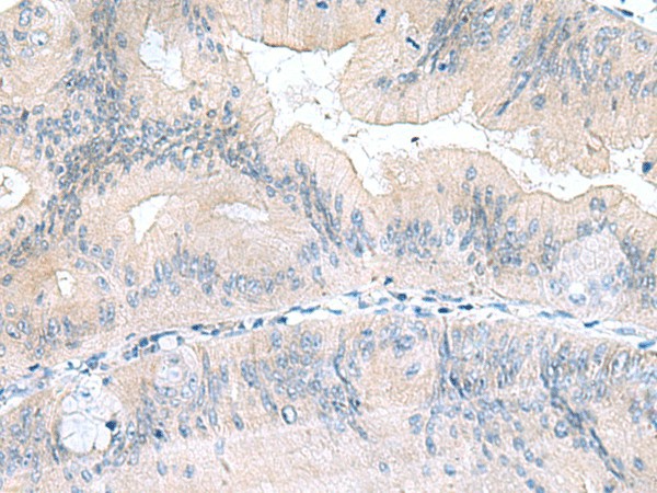 Immunohistochemistry of paraffin-embedded Human colorectal cancer tissue  using UBE2F Polyclonal Antibody at dilution of 1:70(?200)