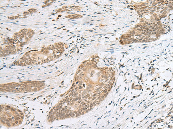 Immunohistochemistry of paraffin-embedded Human esophagus cancer tissue  using CALCOCO1 Polyclonal Antibody at dilution of 1:50(?200)