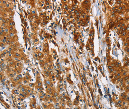 Immunohistochemistry of paraffin-embedded Human gastic cancer using BCAP31 Polyclonal Antibody at dilution of 1:30