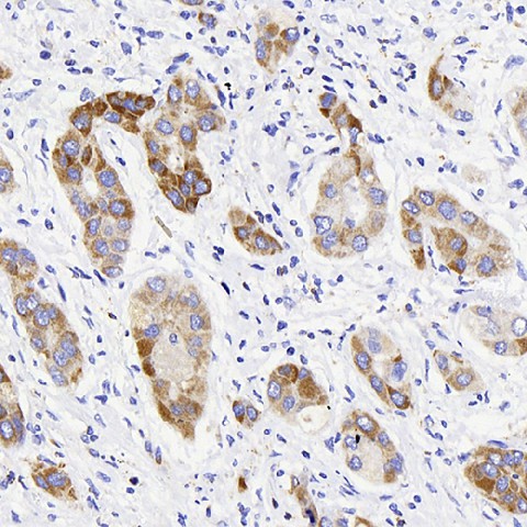 Immunohistochemistry analysis of paraffin-embedded human liver cancer  using ATG5 Polyclonal Antibody at dilution of 1:400.