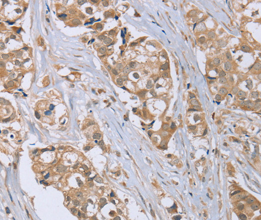 Immunohistochemistry of paraffin-embedded Human breast cancer tissue using RAB6C Polyclonal Antibody at dilution 1:45