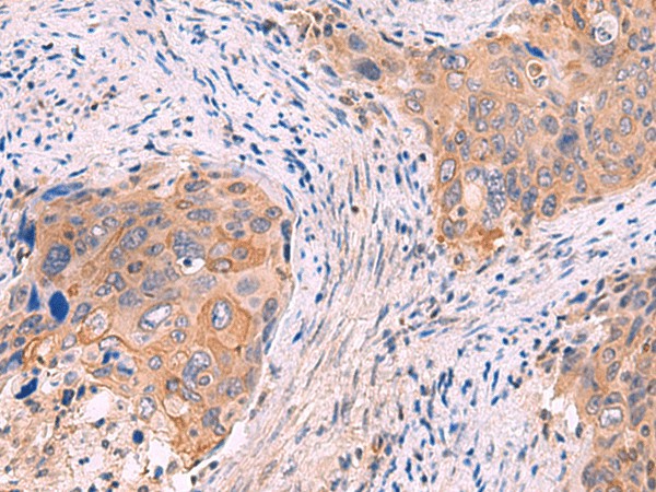 Immunohistochemistry of paraffin-embedded Human cervical cancer tissue  using GSPT2 Polyclonal Antibody at dilution of 1:50(?200)