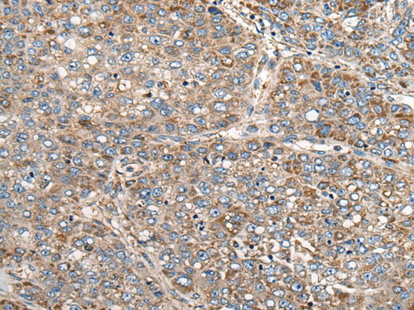 Immunohistochemistry of paraffin-embedded Human liver cancer tissue  using CADM2 Polyclonal Antibody at dilution of 1:40(?200)