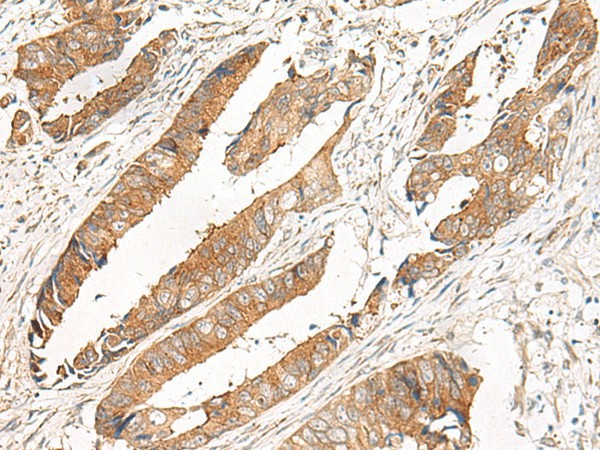 Immunohistochemistry of paraffin-embedded Human colorectal cancer tissue  using GBP4 Polyclonal Antibody at dilution of 1:30(?200)