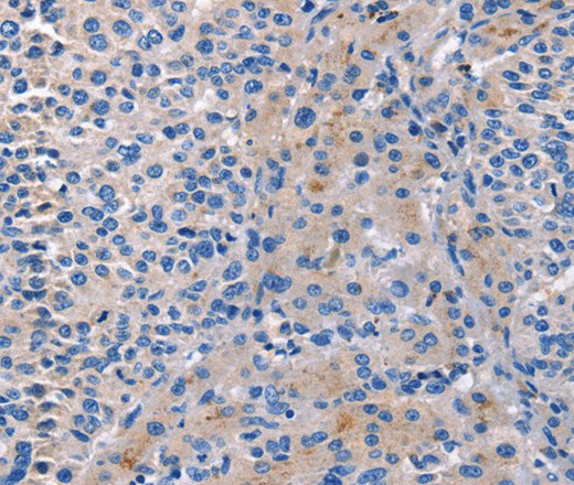 Immunohistochemistry of paraffin-embedded Human liver cancer tissue using CD5L Polyclonal Antibody at dilution 1:40