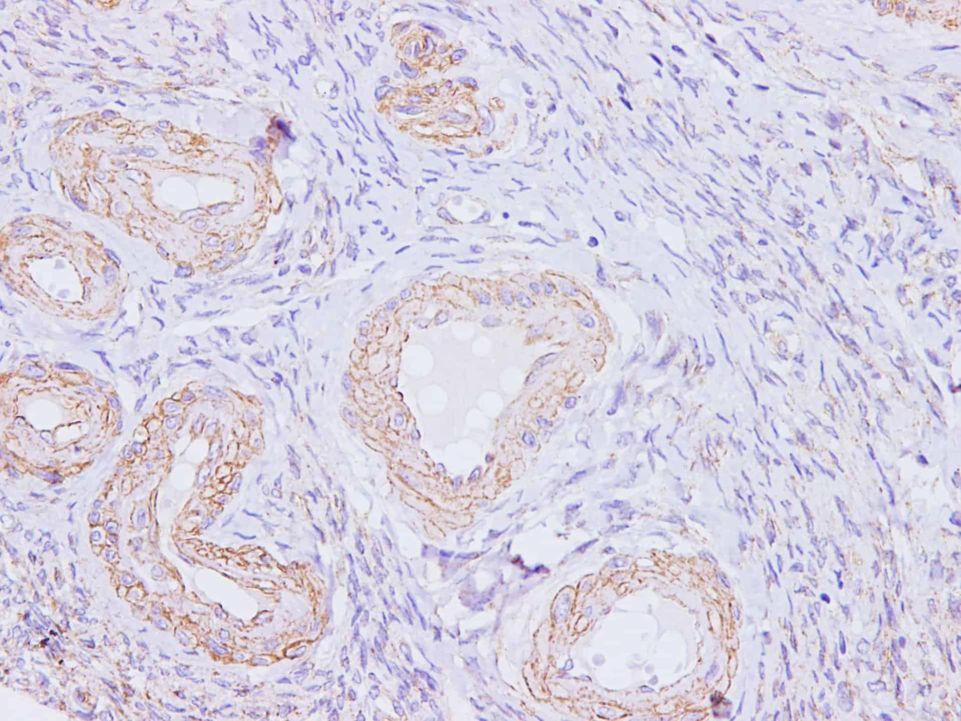 Immunohistochemistry of paraffinembedded Human ovarian using p16 Polyclonal Antibody at dilution of 1:100