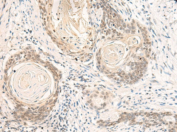 Immunohistochemistry of paraffin-embedded Human esophagus cancer tissue  using DPPA4 Polyclonal Antibody at dilution of 1:55(?200)