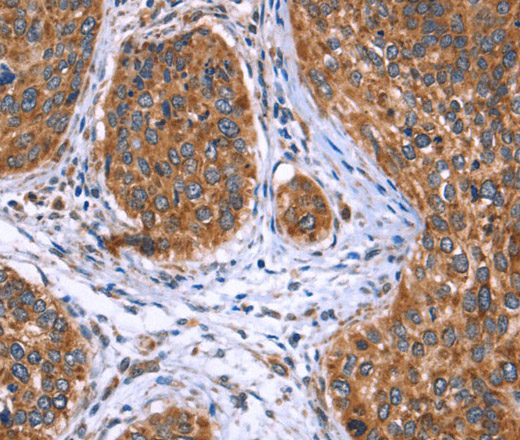 Immunohistochemistry of paraffin-embedded Human cervical cancer tissue using EVC2 Polyclonal Antibody at dilution 1:40