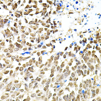 Immunohistochemistry of paraffin-embedded Human lung cancer using PNKP Polyclonal Antibody at dilution of  1:100 (40x lens).