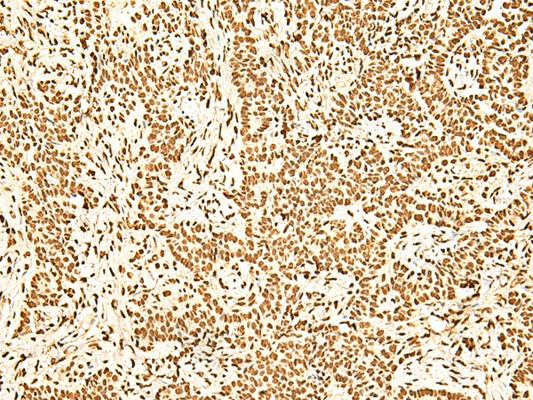 Immunohistochemistry of paraffin-embedded Human ovarian cancer tissue  using ILF3 Polyclonal Antibody at dilution of 1:60(?200)