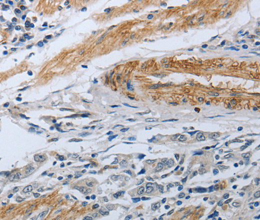 Immunohistochemistry of paraffin-embedded Human gastric cancer using NPR1 Polyclonal Antibody at dilution of 1:30