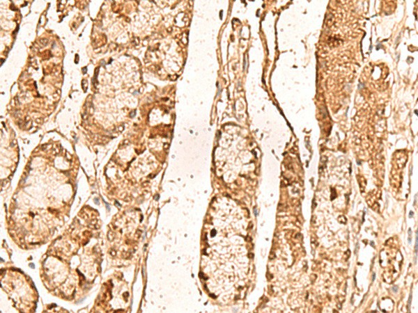 Immunohistochemistry of paraffin-embedded Human liver cancer tissue  using WDR33 Polyclonal Antibody at dilution of 1:65(?200)