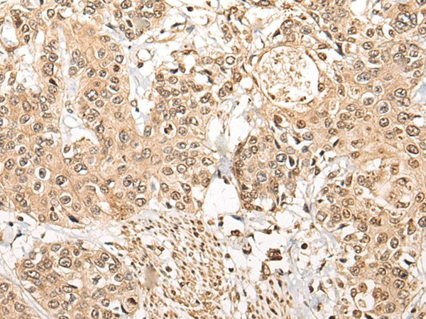 Immunohistochemistry of paraffin-embedded Human prost ate cancer tissue  using NCAPH Polyclonal Antibody at dilution of 1:45(?200)