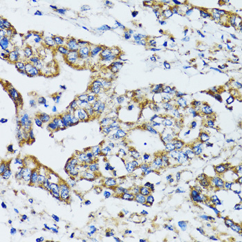 Immunohistochemistry of paraffin-embedded Human colon carcinoma using ATG7 Polyclonal Antibody at dilution of 1:100 (40x lens).