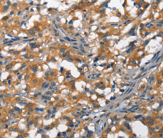 Immunohistochemistry of paraffin-embedded Human thyroid cancer tissue using DDR2 Polyclonal Antibody at dilution 1:40