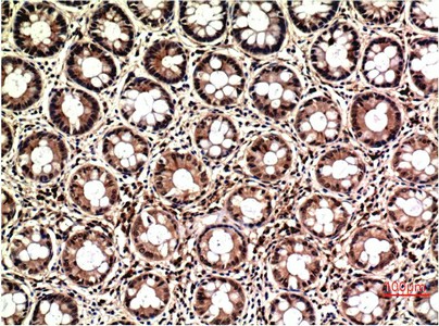 Immunohistochemistry of paraffin-embedded Human colon carcinoma tissue using ERK 1/2 Monoclonal Antibody at dilution of 1:200.