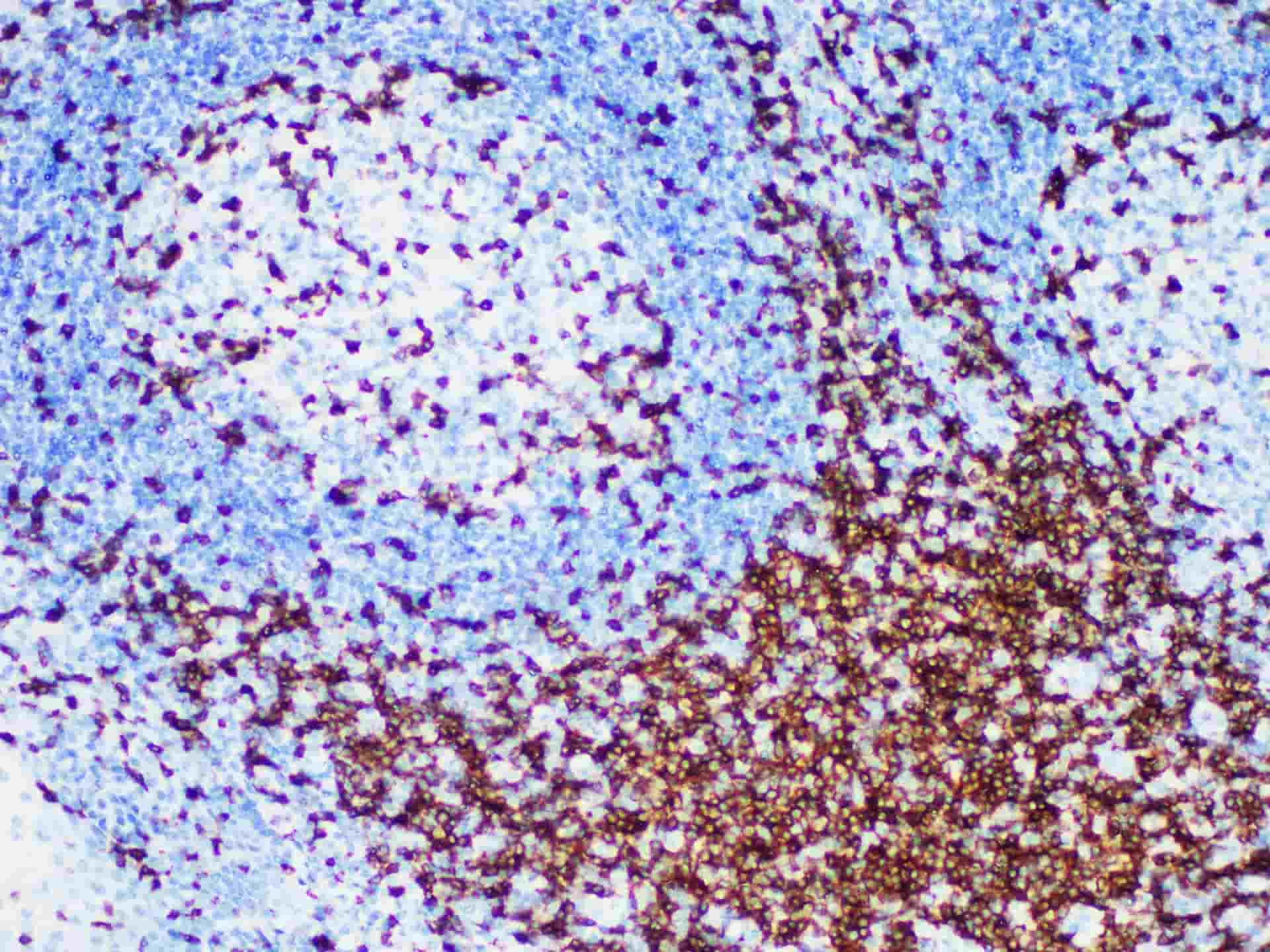 Immunohistochemistry of paraffinembedded Human tonsil tissue with CD7 Monoclonal Antibody(Antigen repaired by EDTA).