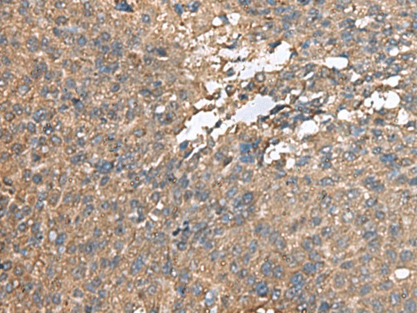 Immunohistochemistry of paraffin-embedded Human liver cancer tissue  using AHNAK Polyclonal Antibody at dilution of 1:100(?200)