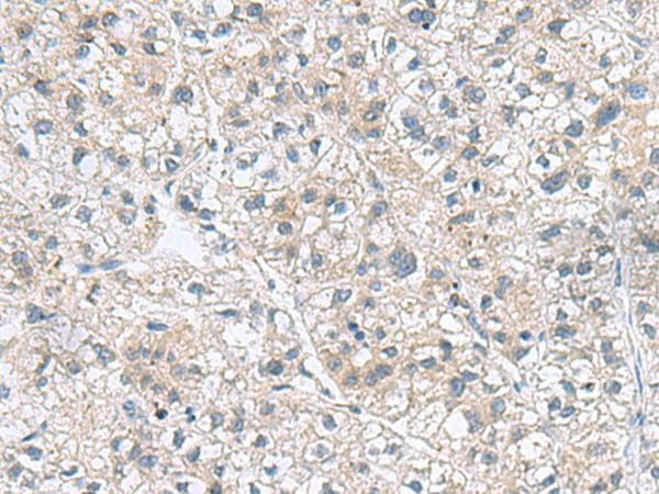 Immunohistochemistry of paraffin-embedded Human liver cancer tissue  using GEMIN7 Polyclonal Antibody at dilution of 1:70(?200)