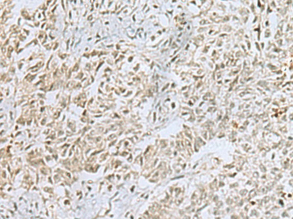 Immunohistochemistry of paraffin-embedded Human ovarian cancer tissue  using FOXQ1 Polyclonal Antibody at dilution of 1:25(?200)