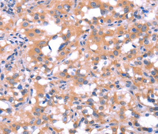 Immunohistochemistry of paraffin-embedded Human thyroid cancer tissue using FAT1 Polyclonal Antibody at dilution 1:40