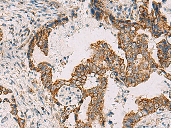 Immunohistochemistry of paraffin-embedded Human cervical cancer tissue  using PDHA1 Polyclonal Antibody at dilution of 1:50(?200)