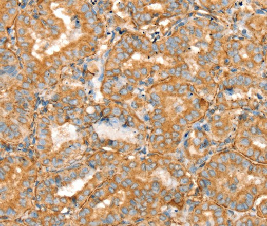 Immunohistochemistry of paraffin-embedded Human thyroid cancer using SLC16A8 Polyclonal Antibody at dilution of 1:40