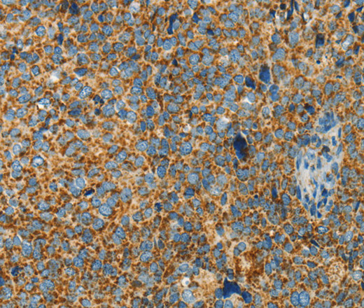 Immunohistochemistry of paraffin-embedded Human cervical cancer using BCAT2 Polyclonal Antibody at dilution of 1:70