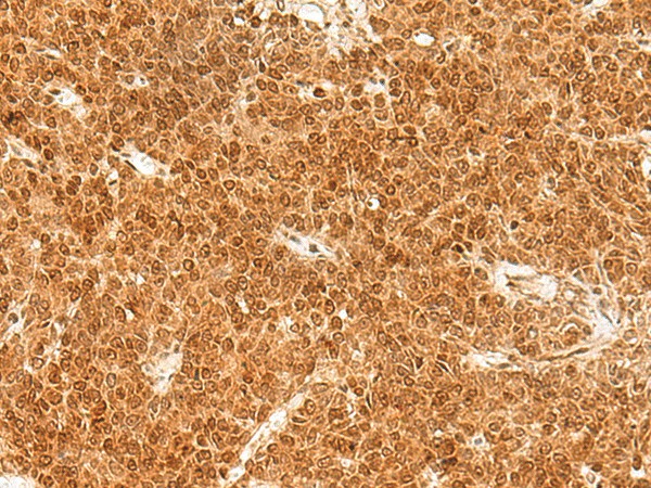 Immunohistochemistry of paraffin-embedded Human ovarian cancer tissue  using TOR1A Polyclonal Antibody at dilution of 1:30(?200)