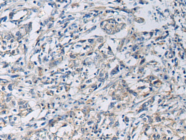 Immunohistochemistry of paraffin-embedded Human gastric cancer tissue  using KCNJ10 Polyclonal Antibody at dilution of 1:60(?200)