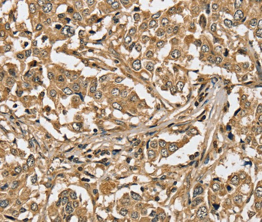 Immunohistochemistry of paraffin-embedded Human liver cancer using PPP1CC Polyclonal Antibody at dilution of 1:40