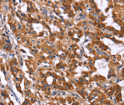 Immunohistochemistry of paraffin-embedded Human thyroid cancer tissue using HACE1 Polyclonal Antibody at dilution 1:40