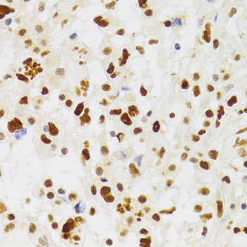 Immunohistochemistry of paraffin-embedded Human brain astrocytoma using NASP Polyclonal Antibody at dilution of 1:100 (40x lens).