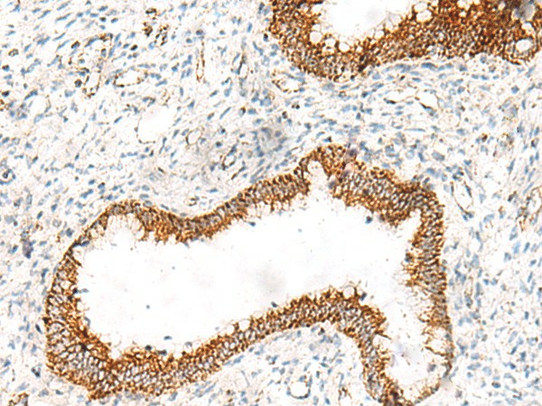 Immunohistochemistry of paraffin-embedded Human cervical cancer tissue  using ORC4 Polyclonal Antibody at dilution of 1:70(?200)