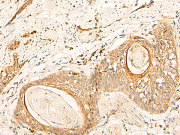 Immunohistochemistry of paraffin-embedded Human esophagus cancer tissue  using EIF3C Polyclonal Antibody at dilution of 1:35(?200)