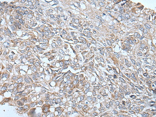 Immunohistochemistry of paraffin-embedded Human lung cancer tissue  using ETFB Polyclonal Antibody at dilution of 1:40(?200)