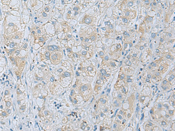 Immunohistochemistry of paraffin-embedded Human liver cancer tissue  using NAGK Polyclonal Antibody at dilution of 1:35(?200)