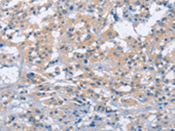 Immunohistochemistry of paraffin-embedded Human thyroid cancer tissue  using ZAP70  Polyclonal Antibody at dilution of 1:50(?200)