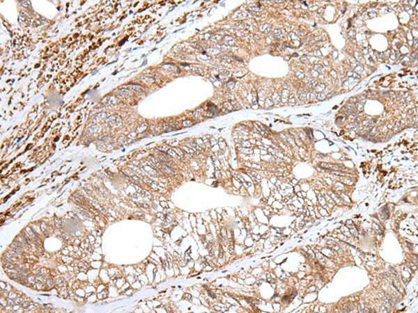 Immunohistochemistry of paraffin-embedded Human colorectal cancer tissue  using ENPEP Polyclonal Antibody at dilution of 1:65(?200)