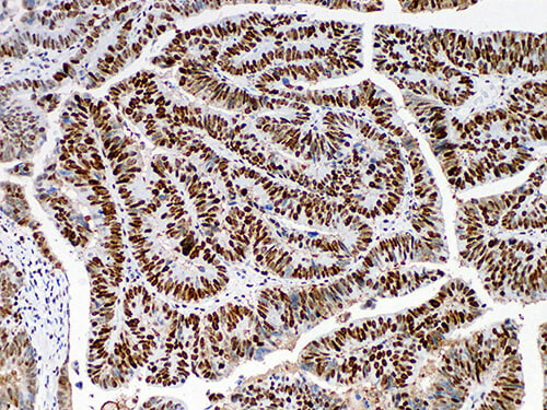 Immunohistochemistry of paraffinembedded Human colon cancer tissue with MutS Protein Homolog 6(MSH6) Monoclonal Antibody(Antigen repaired by EDTA).