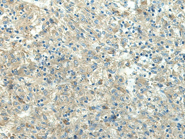 Immunohistochemistry of paraffin-embedded Human liver cancer tissue  using FCGRT Polyclonal Antibody at dilution of 1:65(?200)