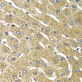 Immunohistochemistry of paraffin-embedded Human liver damage using TMED10 Polyclonal Antibody at dilution of 1:100 (40x lens).