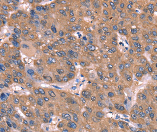 Immunohistochemistry of paraffin-embedded Human liver cancer tissue using GCSAM Polyclonal Antibody at dilution 1:40