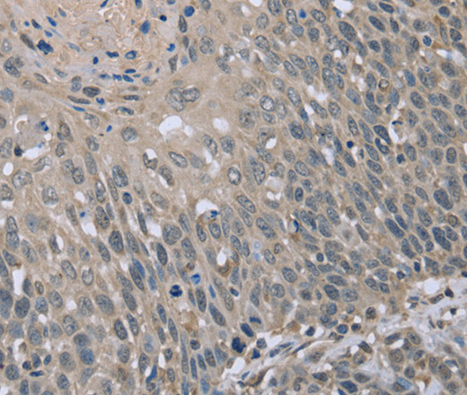 Immunohistochemistry of paraffin-embedded Human cervical cancer tissue using BMX Polyclonal Antibody at dilution 1:30