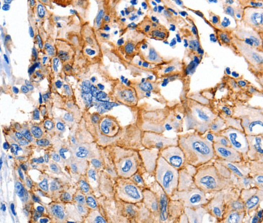 Immunohistochemistry of paraffin-embedded Human cervical cancer using Claudin 1 Polyclonal Antibody at dilution of 1:150