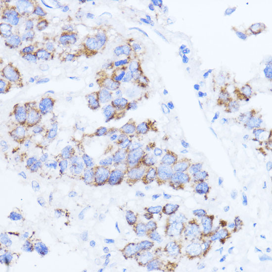 Immunohistochemistry of paraffin-embedded Human liver cancer using ACAT1 Polyclonal Antibody at dilution of 1:100 (40x lens).